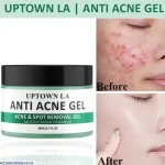Uptown LA Anti Acne Gel 50ml Oil Control