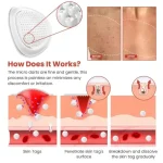 DermaSmooth Skin Tag Remover Patch - Image 4