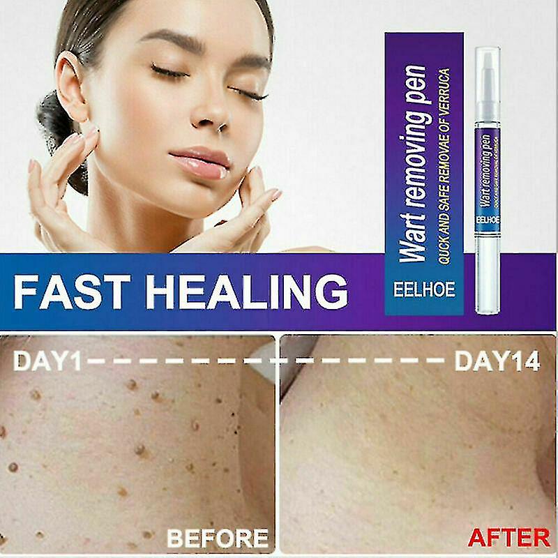 365c7055-9ee1-4c61-afae-d644c2b1aad9.jpeg Warts Remover Original Cream Wart Removal Ointment Wart Treatment Skin Tag Mole Remover Antibacterial Foot Wart - Image 1
