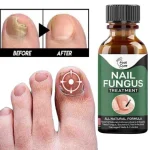 Fast Nail Fungal Treatments Nail Repair Essences Serum Care Treatments Foot Nail Fungus Removal Gel - Image 4