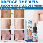 30ml Varicose Veins Treatment Spray Varicose Vein Treatment Cream Repair Varicocele Removal Pain Relief Kidney Inflammation Legs Vein Health Care Spray - Image 2
